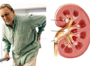 Hỏi đáp: Sỏi thận có gây đau lưng không thưa bác sĩ? 